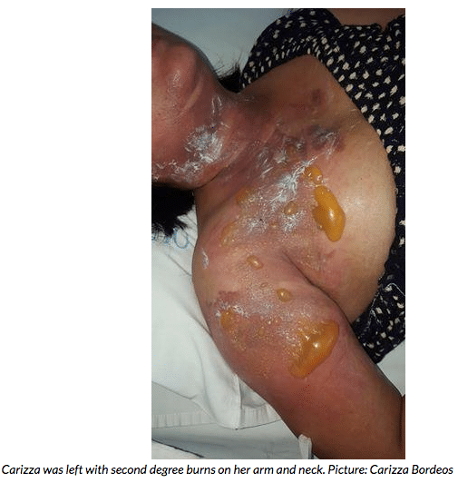 Pressure Cooker Burn Injury - Carizza